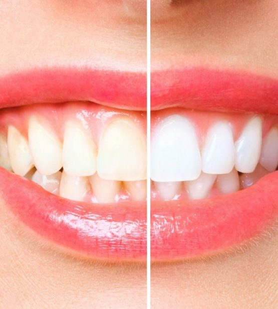 FORMATION BLANCHIMENT DENTAIRE AMERICAIN NALHYA ACADEMY MONTPELLIER MARSEILLE PERPIGNAN